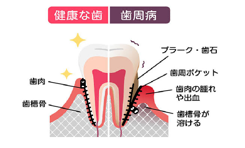 写真：歯周病についての考え